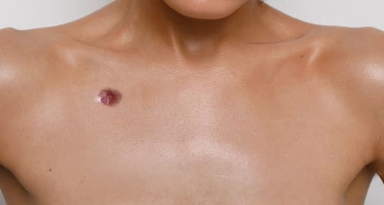 The Day Clinic - Skin Cancer
