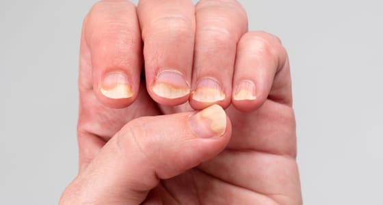The Day Clinic - Fungal Infections