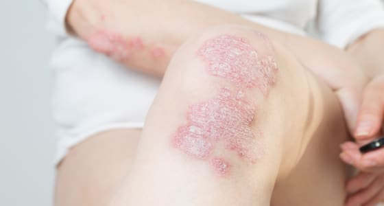 The Day Clinic - Psoriasis