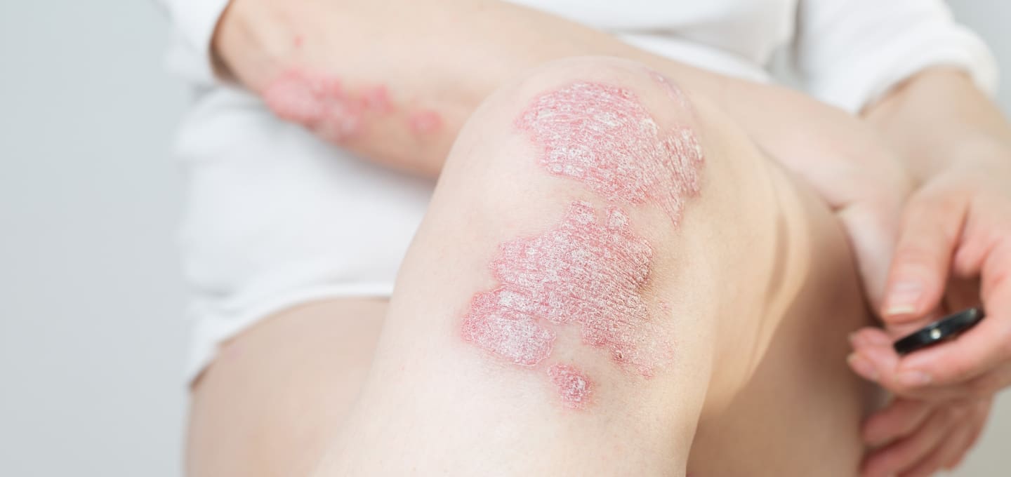 The Day Clinic - Psoriasis