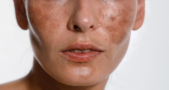 The Day Clinic - Skin Discolouration