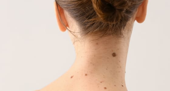 A Girl with moles on a Body