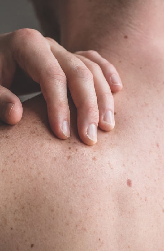 Moles On A Persons Back