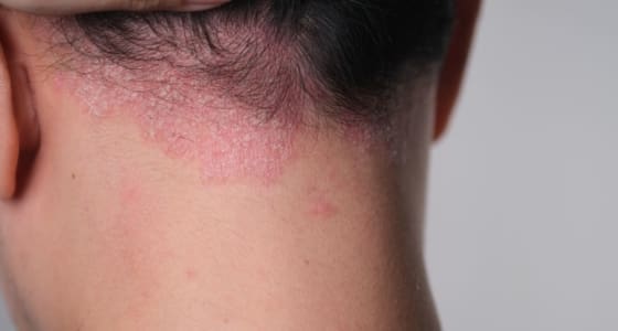 Psoriasis on back of the neck