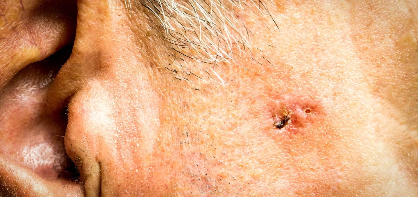 The Day Clinic - Basal Cell Carcinoma