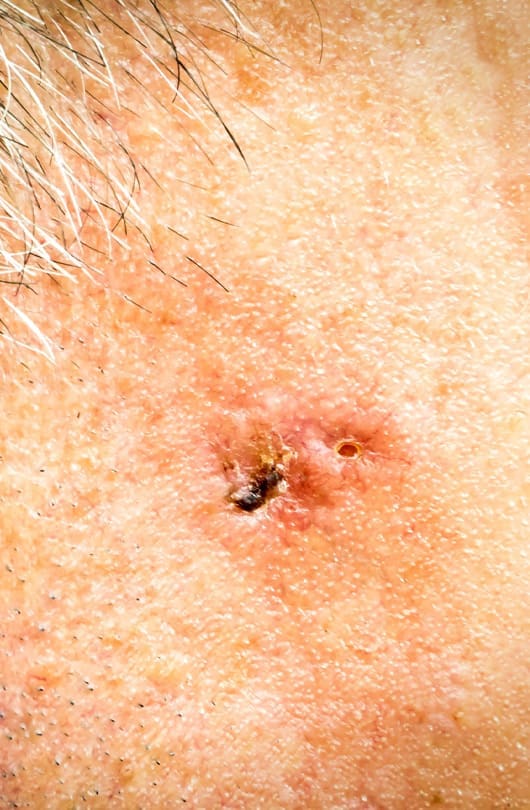 The Day Clinic - Basal Cell Carcinoma
