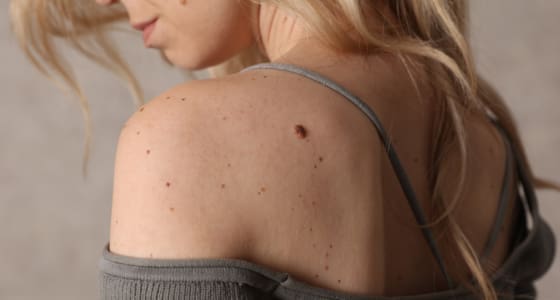 The Day Clinic - Skin Tags
