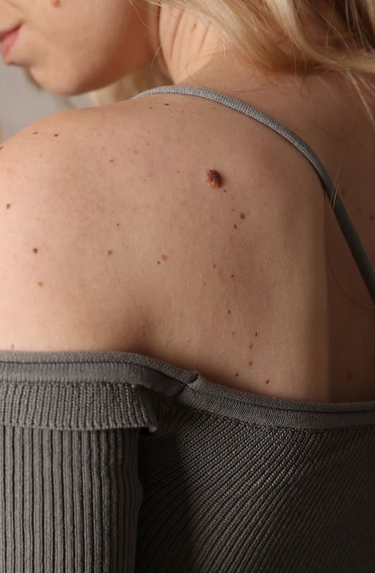 The Day Clinic - Skin Tags
