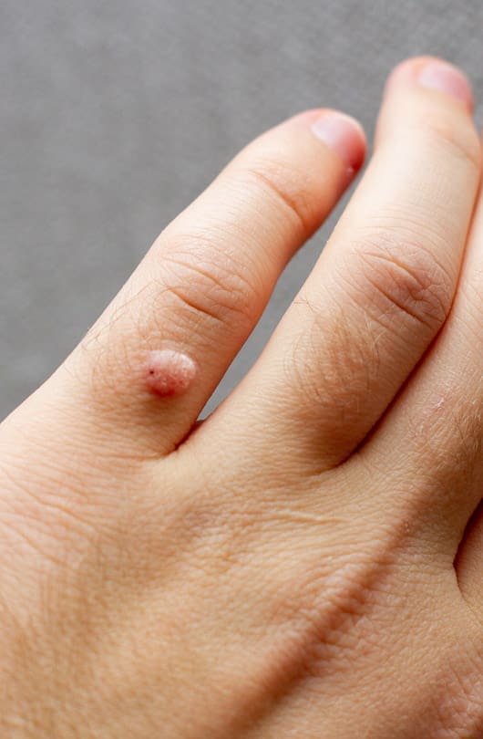 Warts - Precancerous Skin Treatment - The Day Clinic