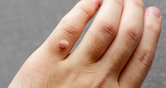 Wart on a persons finger