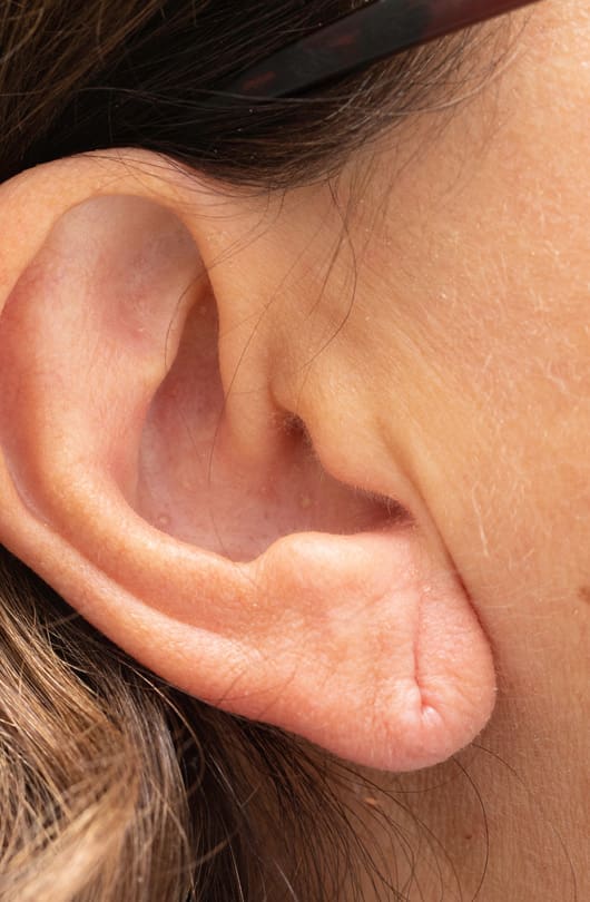 Split Earlobe Surgery