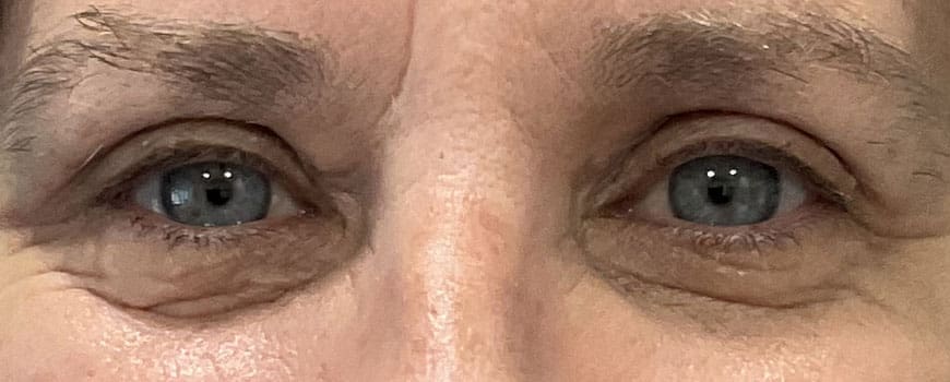 A close up of a patients eyes after blepharoplasty