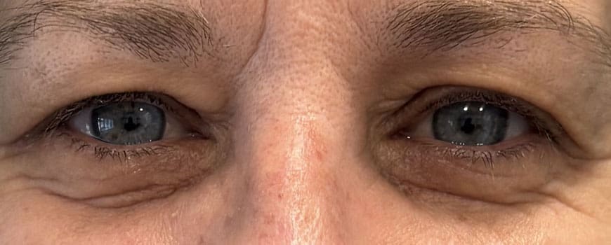 A close up of a patients eyes before blepharoplasty