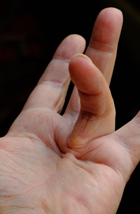 The Day Clinic - Dupuytren’s Contracture