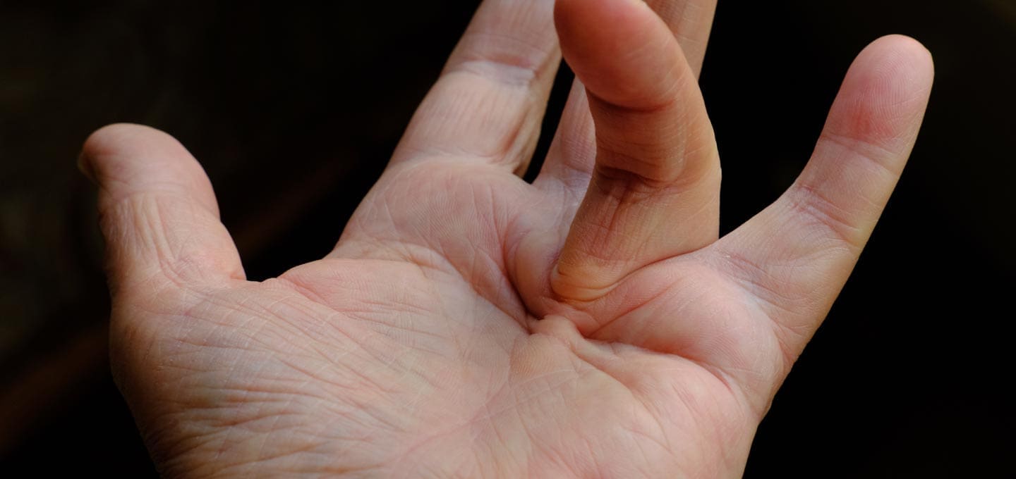 The Day Clinic - Dupuytren’s Contracture