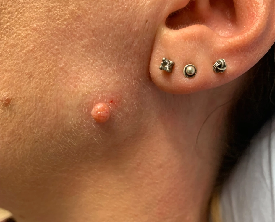 Dermatology Clinic Cambridge Patient Before Treatment